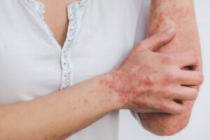 Propolis und Neurodermitis: Potenzielle Linderung für Hautprobleme. 3 psoriasis 5996424 640