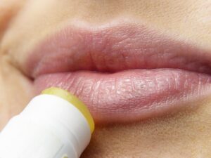 Herpes: Vorbeugung und natürliche Behandlung von Lippenherpes. 2 Herpes